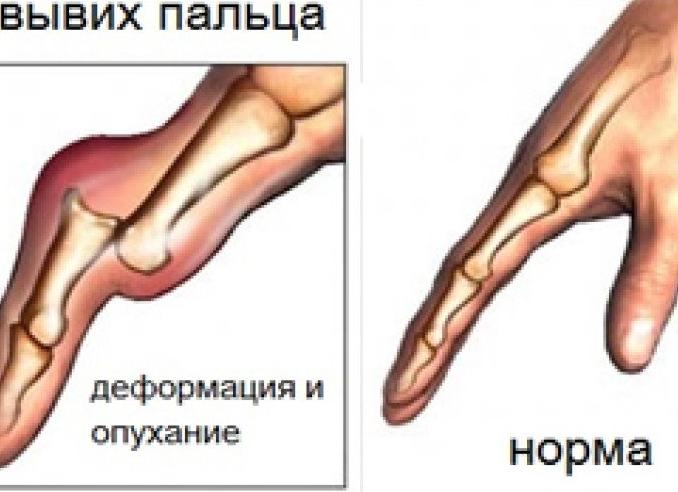 Вывих пальца