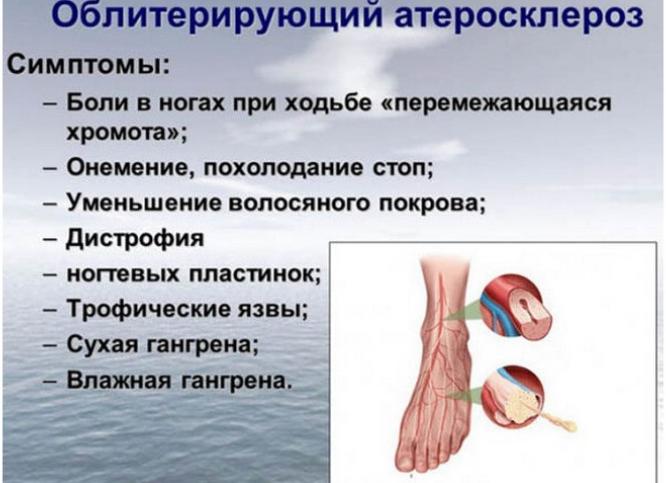 Артериосклероз: причины, симптомы, методы лечения