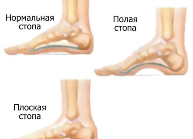 Конская стопа
