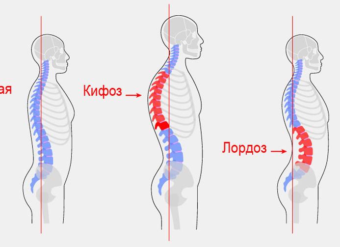 Кифоз
