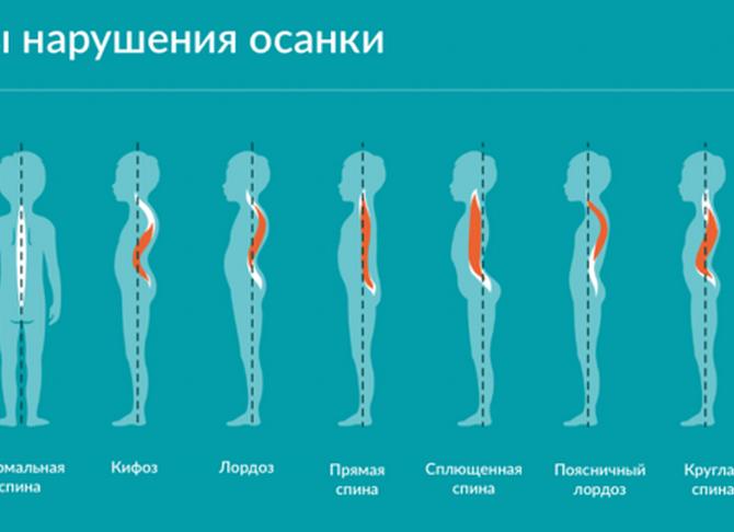 Нарушения осанки