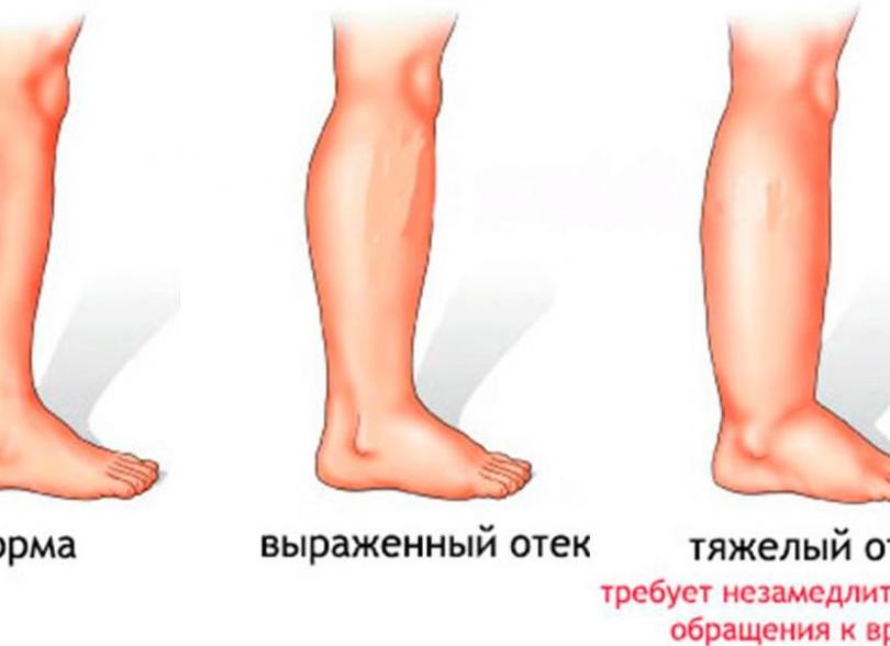 Отечность