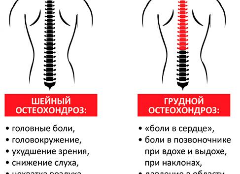 Признаки грудного остеохондроза