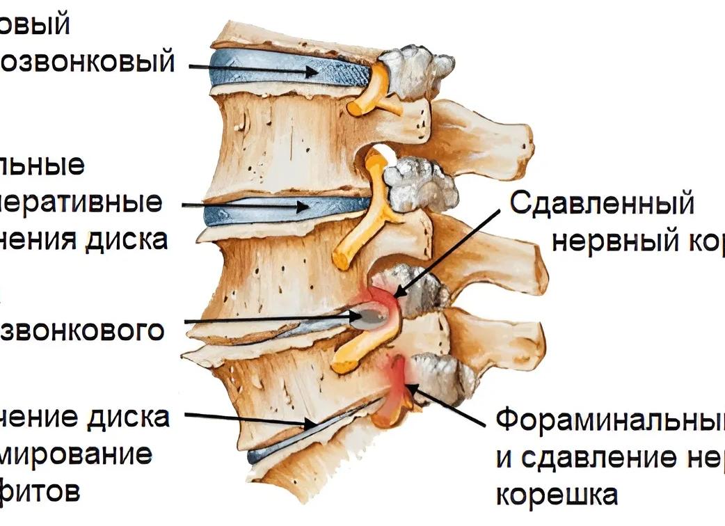 Корешковый синдром и его лечение