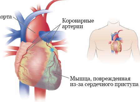 Спазмы в мышцах