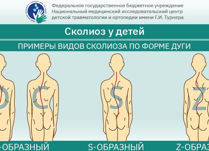 C-образный сколиоз