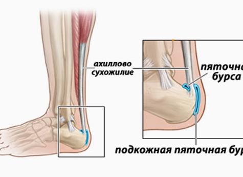 Ахиллодиния