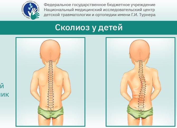 Лечение сколиоза