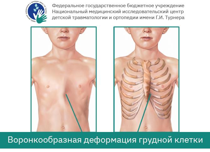 Воронкообразная грудная клетка