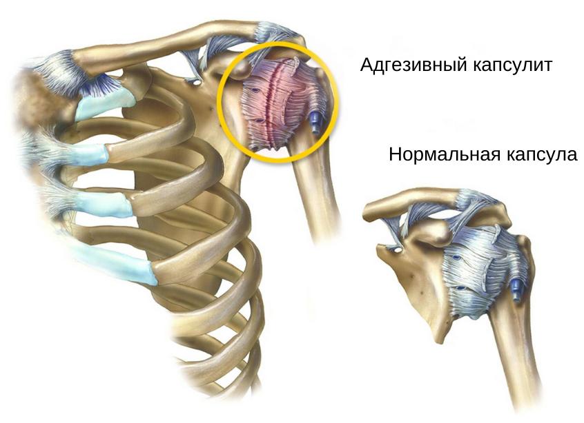 Адгезивный капсулит