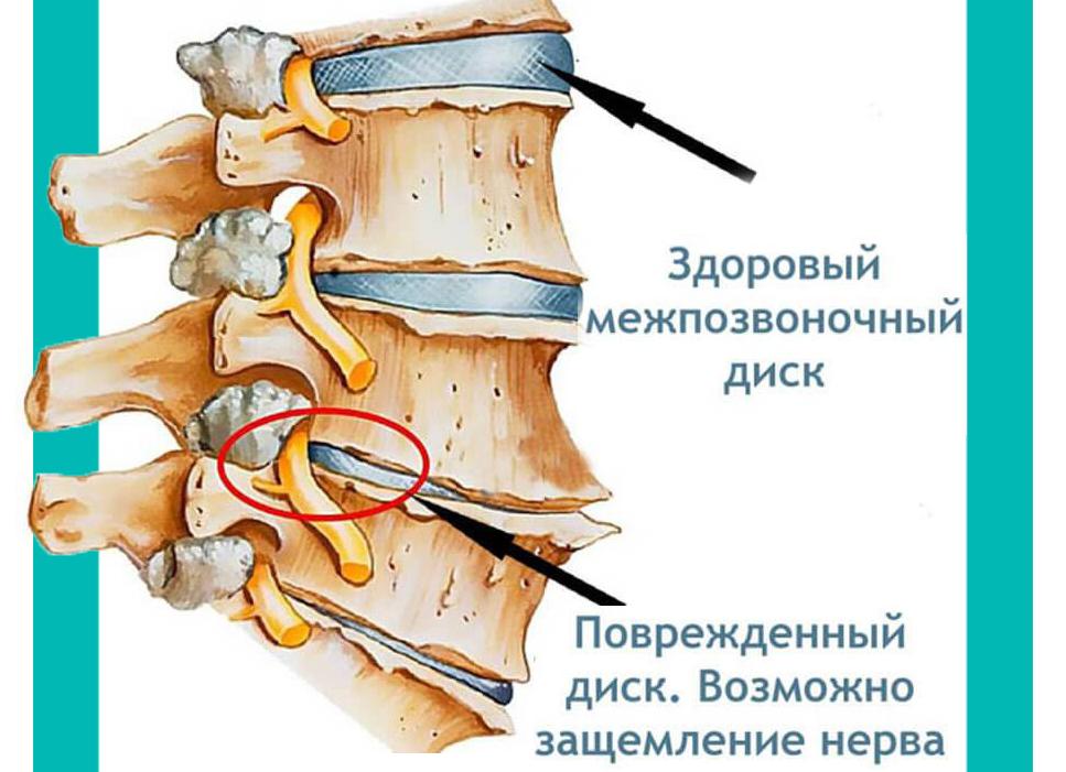 Защемление в спине