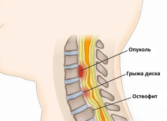 Остеофиты позвоночника: причины и лечение